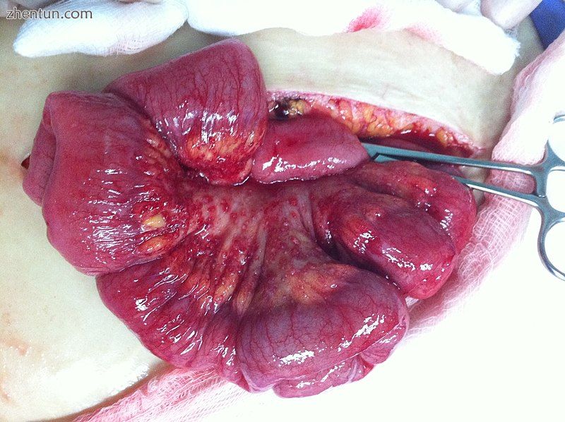 Ovarian adenocarcinoma deposit in the mesentery of the small bowel.jpg