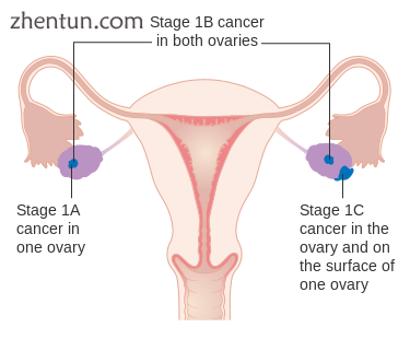 Stage 1 ovarian cancer.png