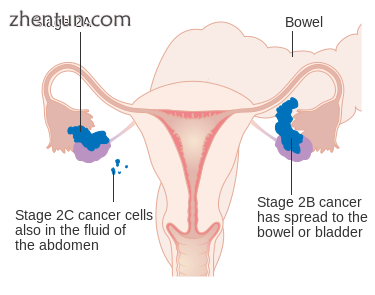 Stage 2 ovarian cancer.png