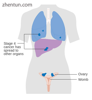 Stage 4 ovarian cancer.png