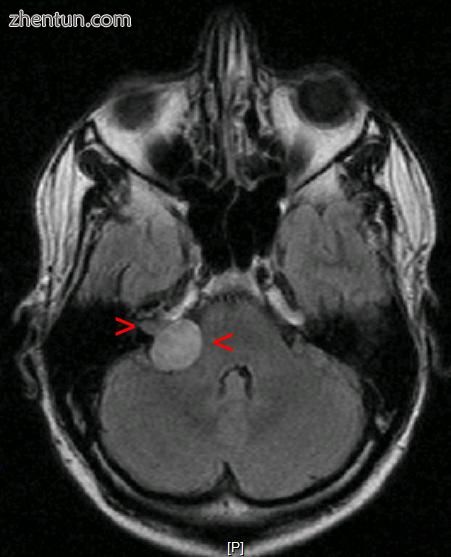 Acoustic neuroma on the right with a size of 20x22x25mm.jpg