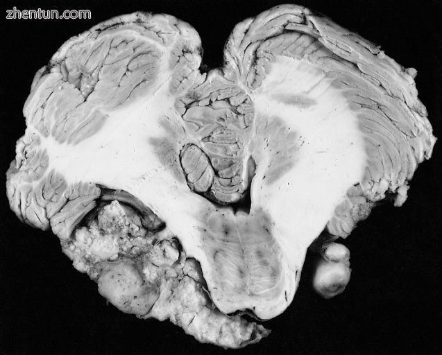 Bilateral schwannomas in a patient with neurofibromatosis 2.jpg