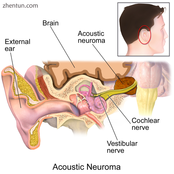 Illustration of acoustic neuroma..png