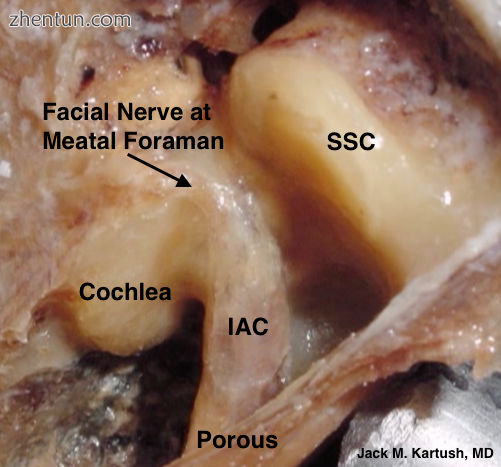 Middle cranial fossa surgical anatomy as demonstrated in a right cadaver tempora.png