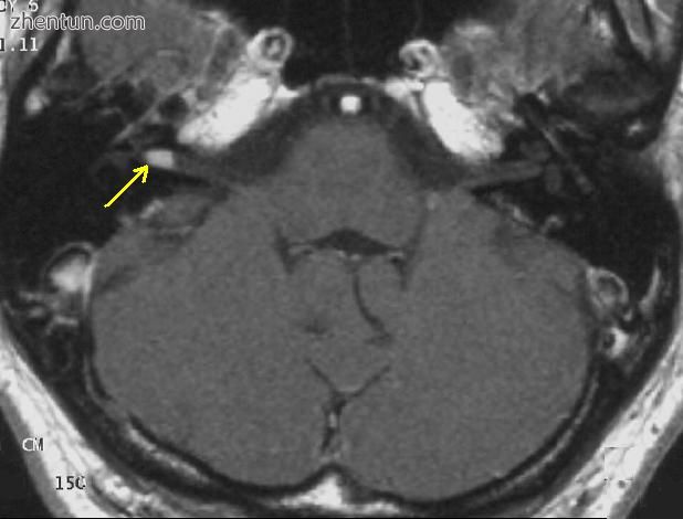 Transversal T1-weighted MRI after contrast small acoustic neuroma.jpg