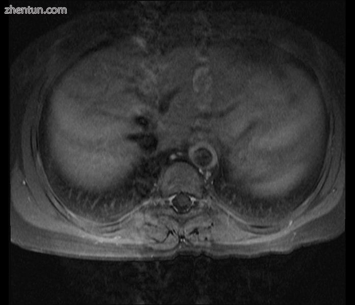 Axial T1-weighted post-gadolinium MRI in a patient with Takayasu arteritis showi.jpg