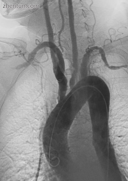 Left anterior oblique angiographic image of Takayasu&#039;s arteritis showing ar.jpg