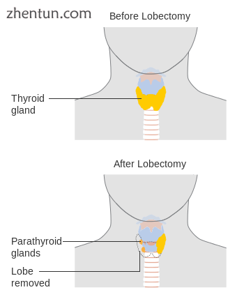 A lobectomy of the thyroid gland.png
