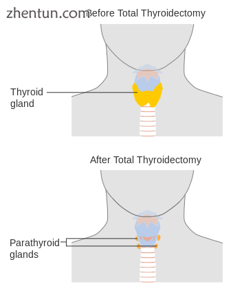 A total thyroidectomy.png