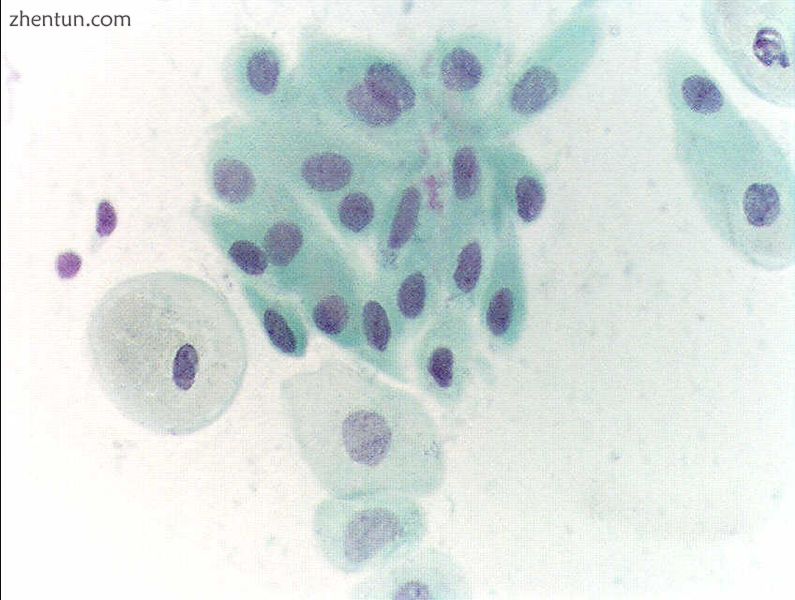 Atrophic squamous cells in postmenopausal women.jpg