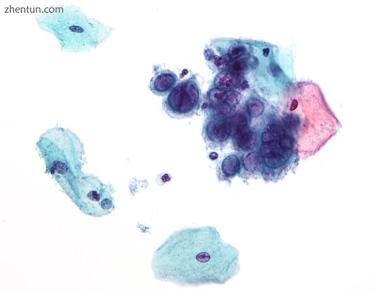 Micrograph of a Pap test showing changes of herpes simplex virus. Pap stain..jpg
