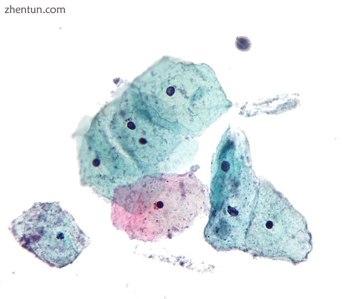 Micrograph of a Pap test showing trichomoniasis. Trichomonas organism seen in th.jpg