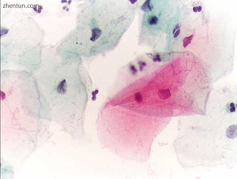 Normal squamous epithelial cells in premenopausal women.jpg
