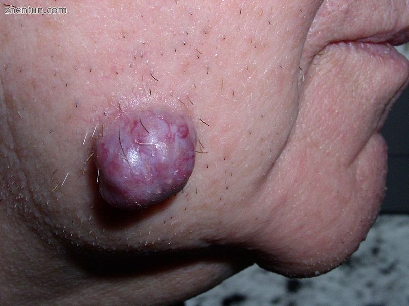 Neoplastic tumor of the cheek skin, here a benign neoplasm of the sweat glands c.jpg
