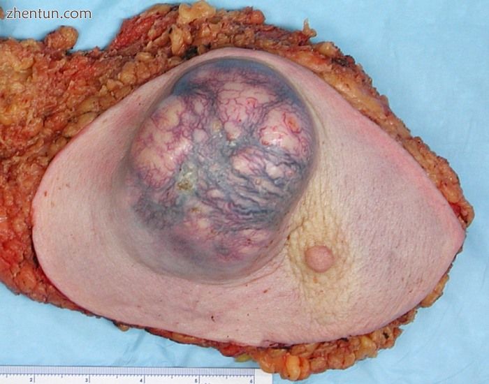 A large invasive ductal carcinoma in a mastectomy specimen.jpg