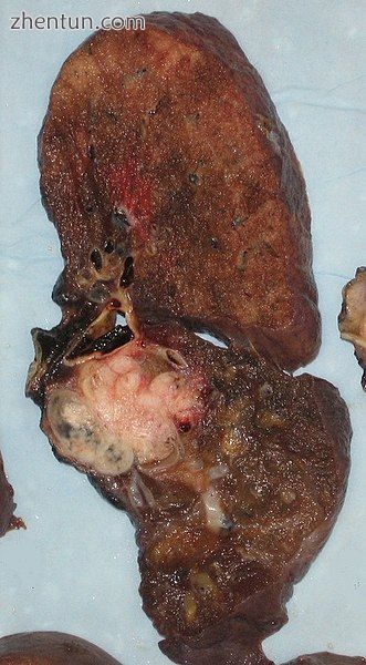 A squamous-cell carcinoma (the whitish tumor) near the bronchi in a lung specimen.jpg