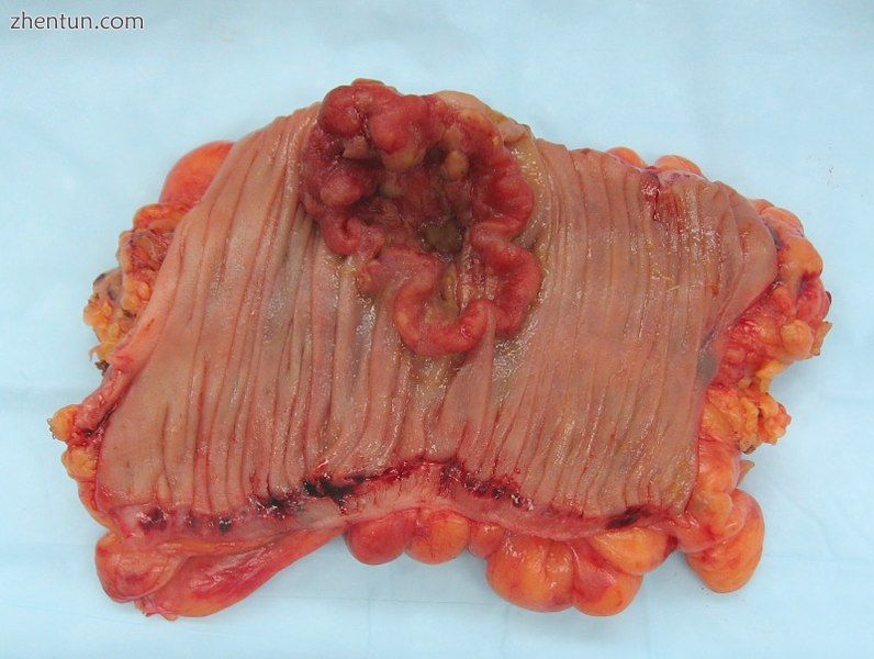 An invasive colorectal carcinoma (top center) in a colectomy specimen.jpg
