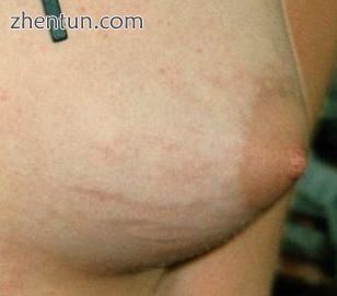 Breast with visible stretch marks.jpg