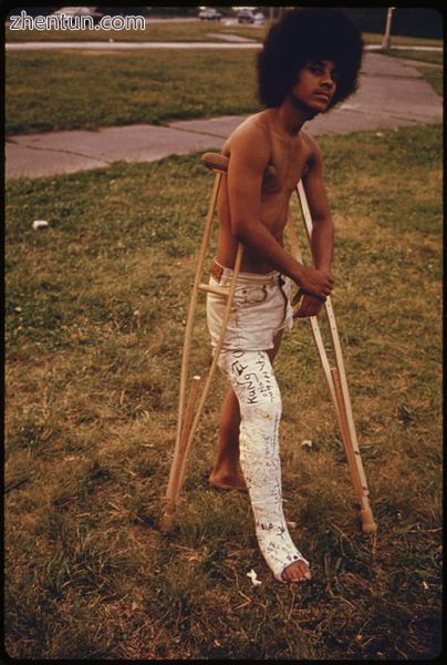 Young man in full leg plaster cast in 1974.jpg
