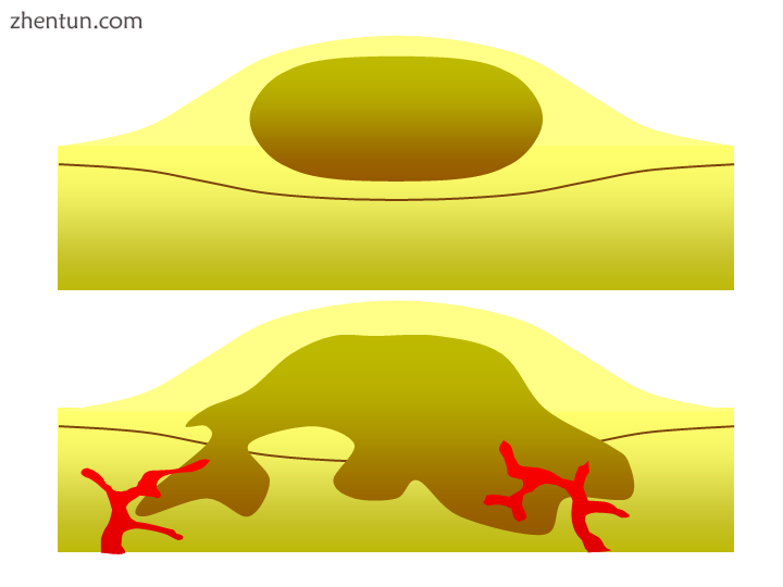 Diagram showing two epithelial tumors. The upper tumor is a be.png