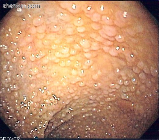 Endoscopic image of sigmoid colon of a patient with familial adenomatous polyposis..jpg
