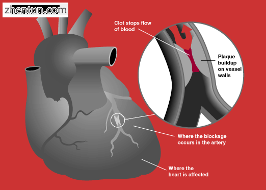 Blockage of a coronary artery.png