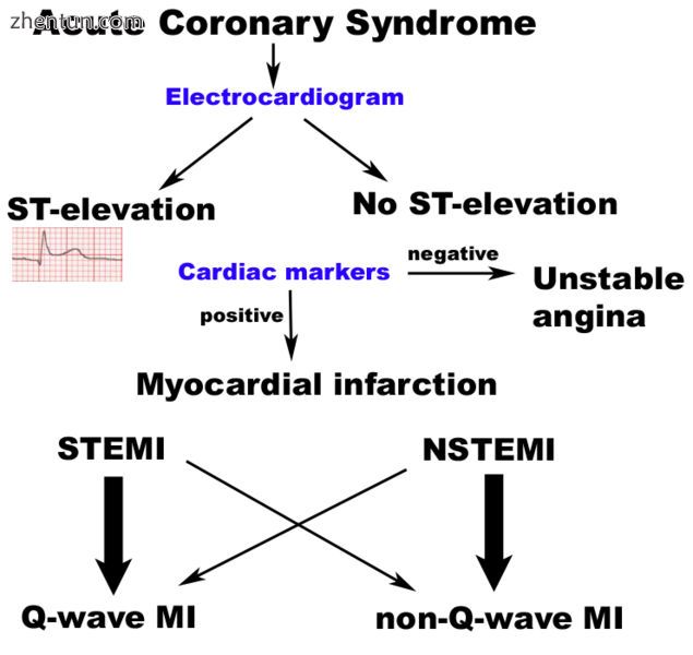 Classification of acute coronary syndromes.[11].jpg