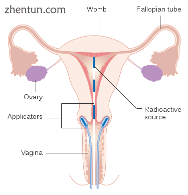 Brachytherapy for cervical cancer.png