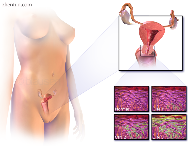 Location of cervical cancer and an example of normal and abnormal cells.png
