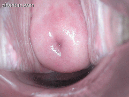 Negative visual inspection with acetic acid of the cervix.gif