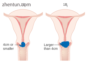 Stage 1B cervical cancer.png