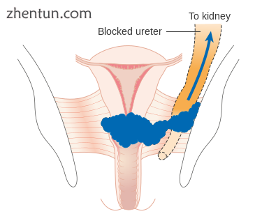 Stage 3B cervical cancer.png