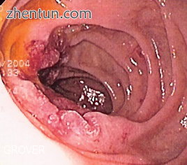 Endoscopic image of adenocarcinoma of duodenum seen in the post-bulbar duodenum..png