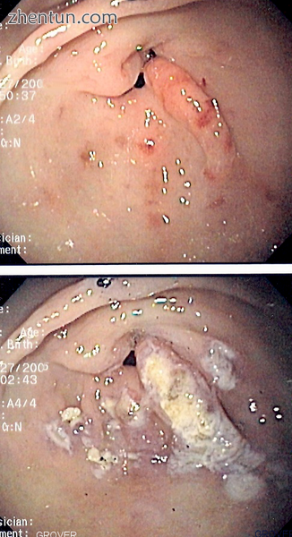 Endoscopic image of gastric antral vascular ectasia seen as a radial pattern aro.png