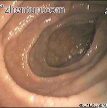 Endoscopic still of duodenum of patient with celiac disease showing scalloping o.jpg