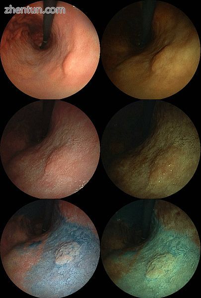 Endoscopic images of an early stage stomach cancer. 0-IIa,.jpg