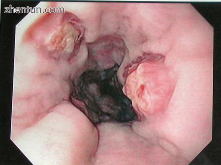 Endoscopic still of esophageal ulcers seen after banding of esophageal varices, .jpg