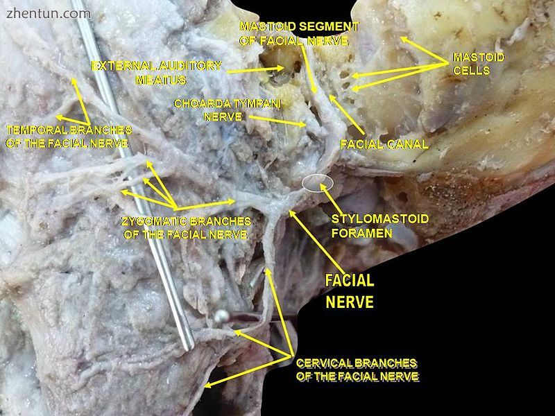 Lateral head anatomy detail.Facial nerve dissection..jpg