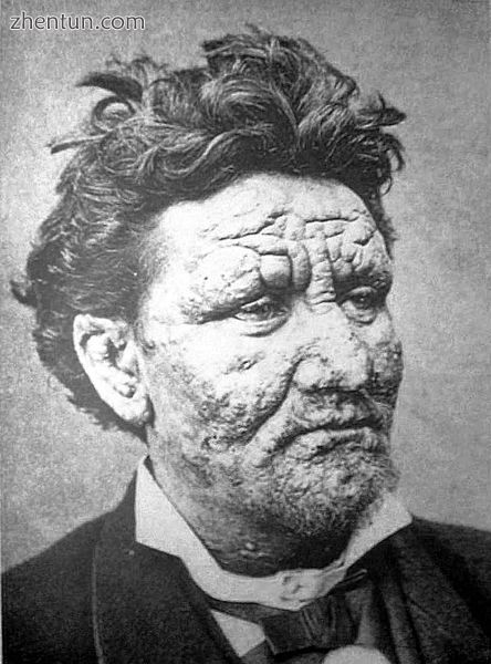 A 24-year-old man with leprosy (1886).jpg