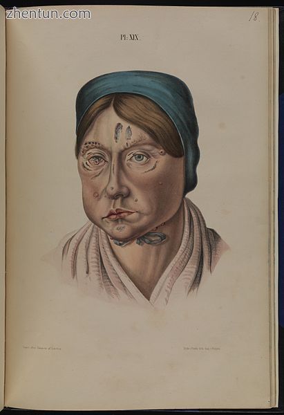 A 26-year-old woman with leprous lesions.jpg