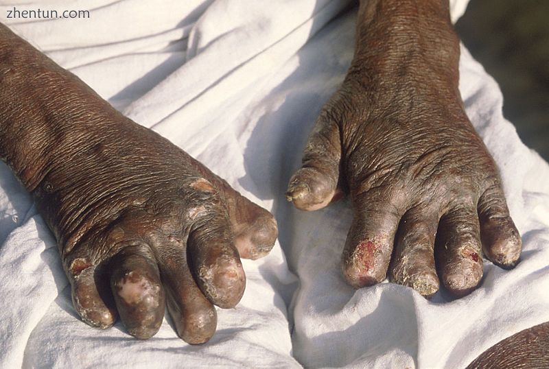 Hands deformed by leprosy.jpg