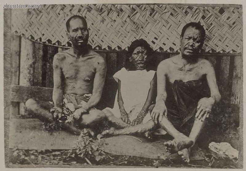 Leprosy in Tahiti, circa 1895.jpg