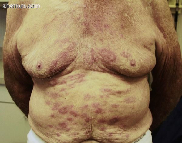 Rash on the chest and abdomen due to leprosy.jpg