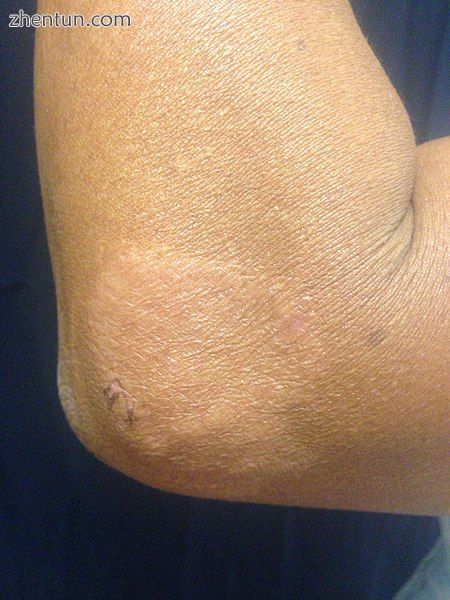 Paucibacillary leprosy (PB) Pale skin patch with loss of sensation.jpg