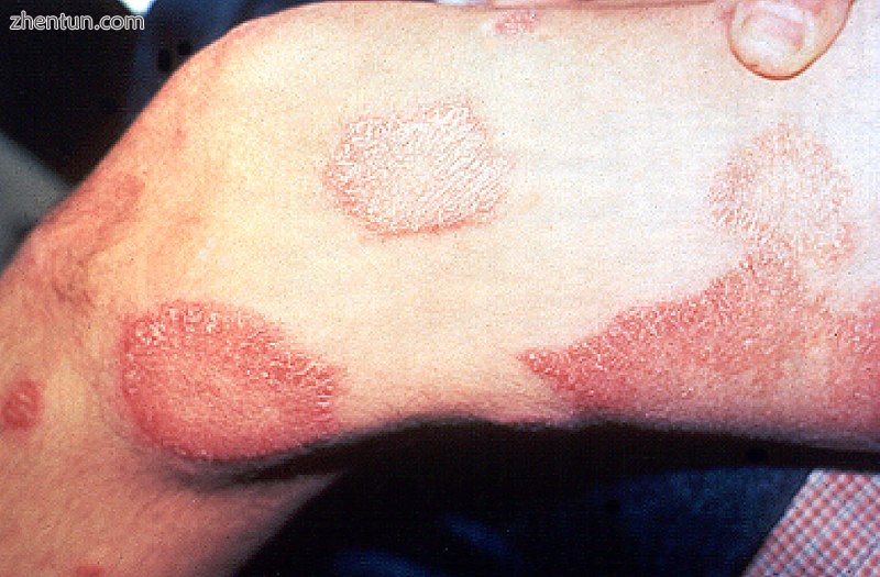 Skin lesions on the thigh of a person with leprosy.jpg