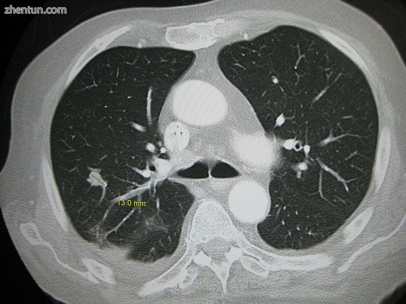 CT image of a lung metastasis.jpg