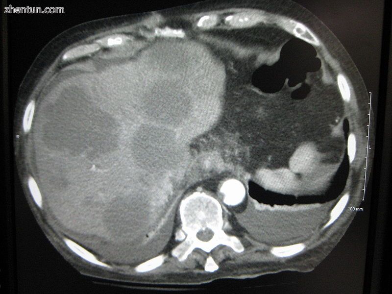 CT image of multiple liver metastases.jpg