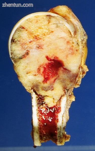 Cut surface of a humerus sawn lengthwise, showing a large cancerous metastasis (.jpg