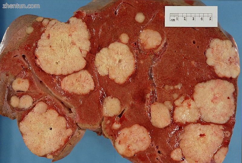 Cut surface of a liver showing multiple paler metastatic nodules originating fro.jpg