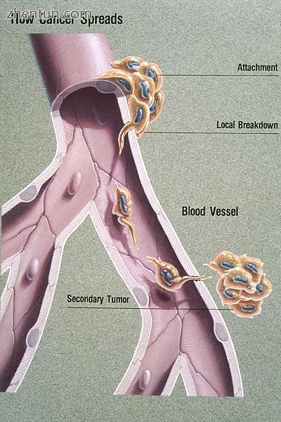 Illustration showing hematogenous metastasis.jpg